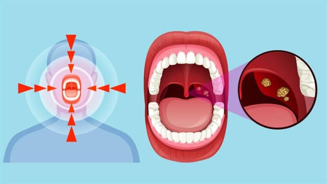 Am I At The Risk Of Tonsillitis?