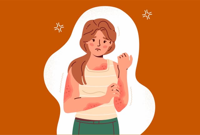 Am I At The Risk Of Eczema?