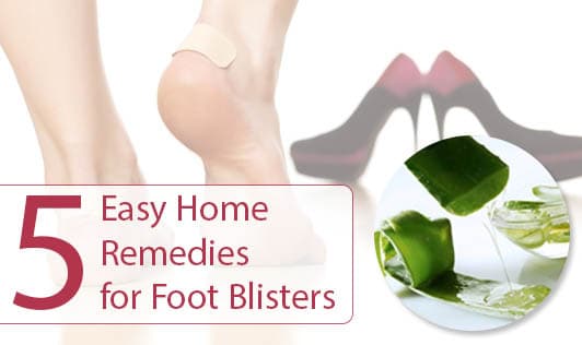5 Easy Home Remedies for Foot Blisters