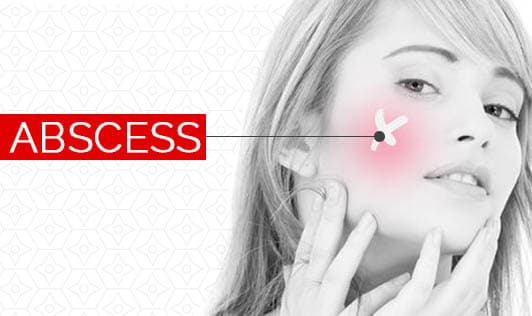 Abscess