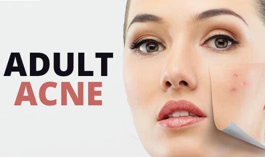 Adult Acne