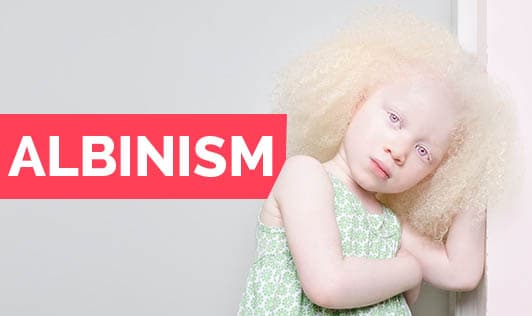 Albinism