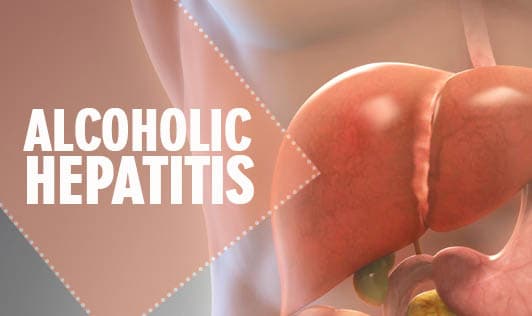 Alcoholic Hepatitis