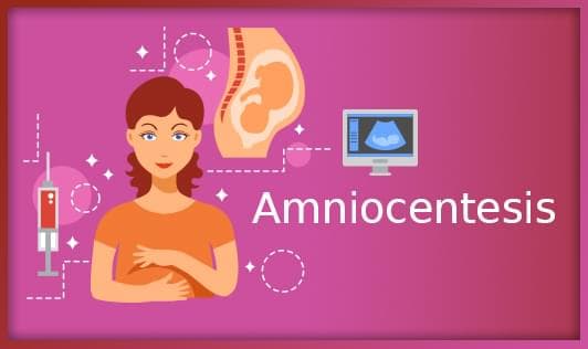 Amniocentesis
