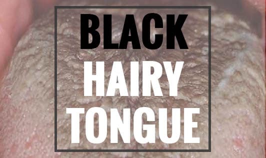Black, hairy tongue