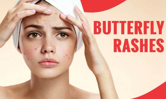 Butterfly rashes