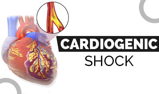 Cardiogenic Shock