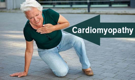 Cardiomyopathy
