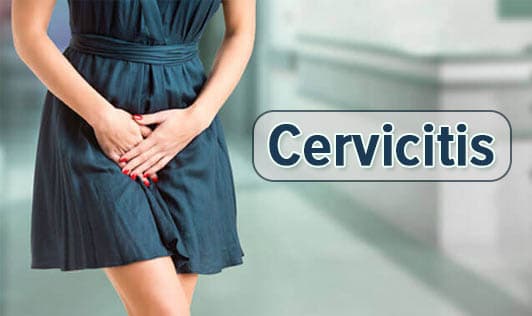 Cervicitis