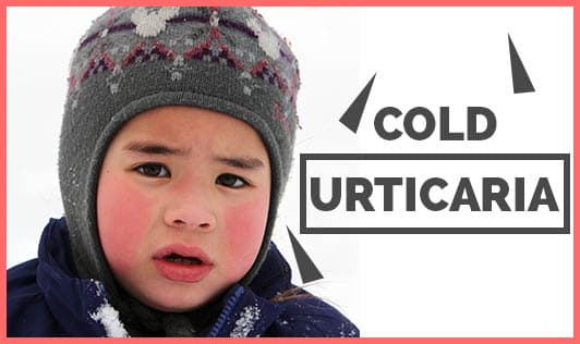 Cold Urticaria