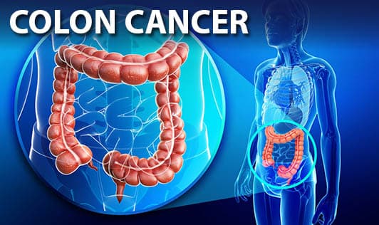 Colon Cancer