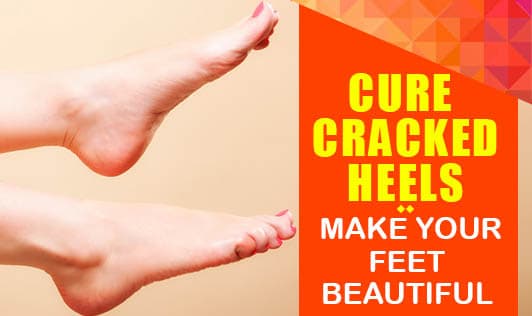Cure Cracked Heels. Make Your Feet Beautiful