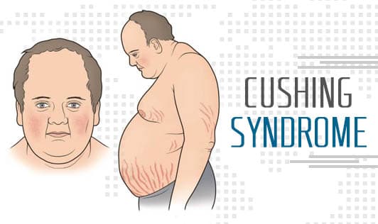 Cushing Syndrome