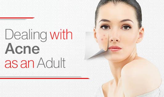 Dealing with Acne as an Adult