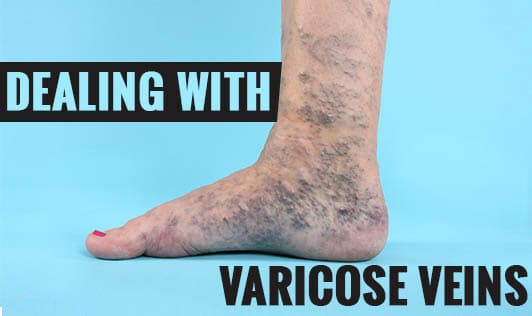 Dealing with Varicose Veins