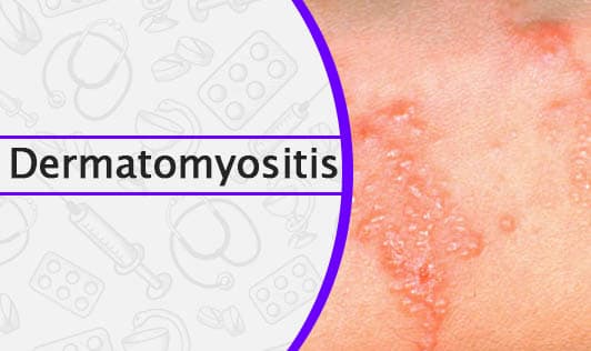 Dermatomyositis