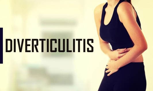 Diverticulitis