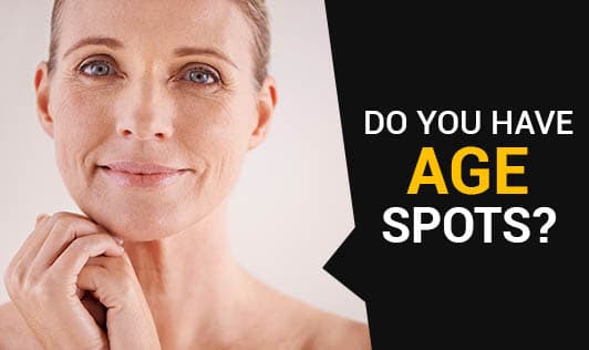 Do You Have Age Spots?