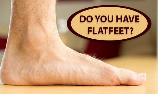 Do you have flatfeet?