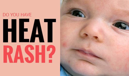Do you have heat rash?