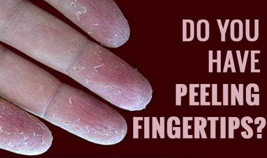 Do you have peeling fingertips?