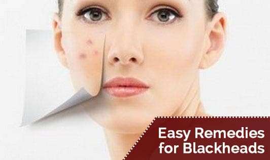 Easy Remedies for Blackheads