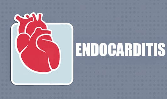 Endocarditis