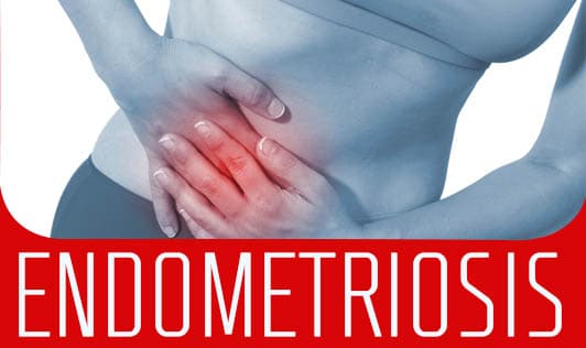 Endometriosis