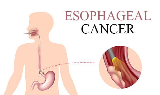 Esophageal Cancer