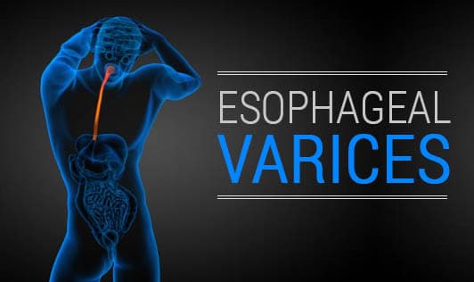 Esophageal Varices
