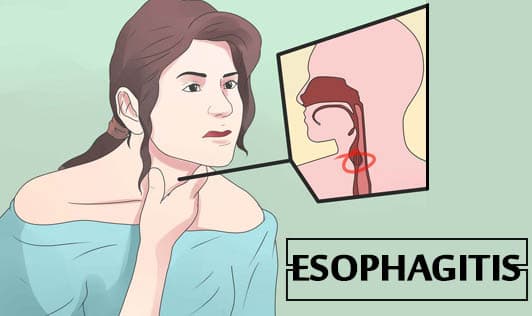 Esophagitis