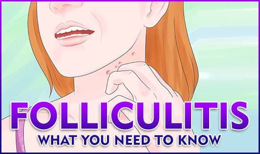 Folliculitis: What you need to know