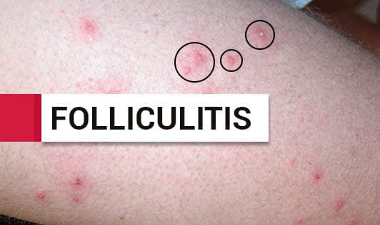 Folliculitis