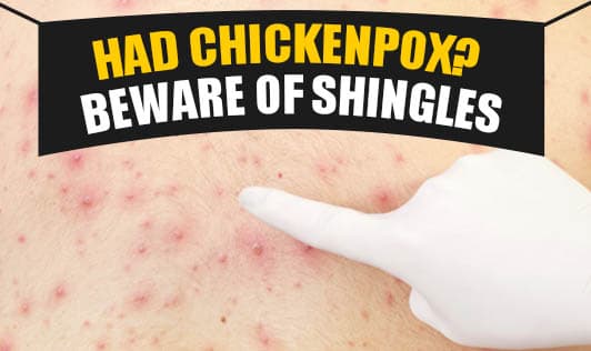 Had Chickenpox? Beware Of Shingles
