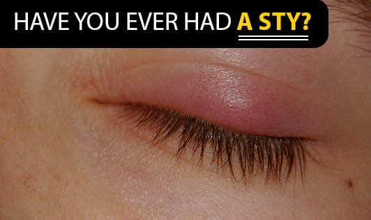 Have you ever had a sty?