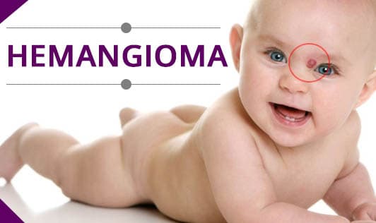 Hemangioma