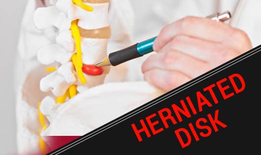 Herniated Disk