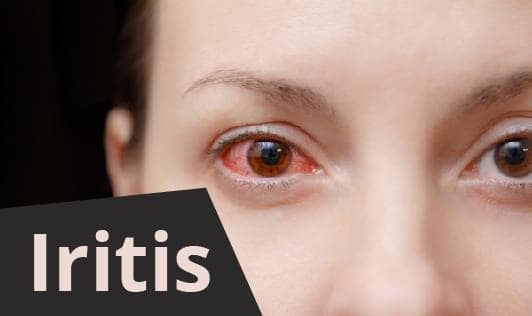 Iritis