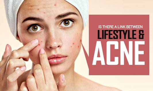 Is there a link between lifestyle and acne?
