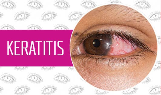 Keratitis