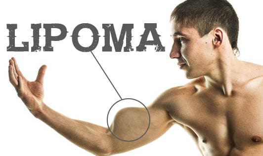 Lipoma