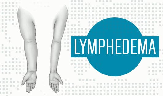 Lymphedema