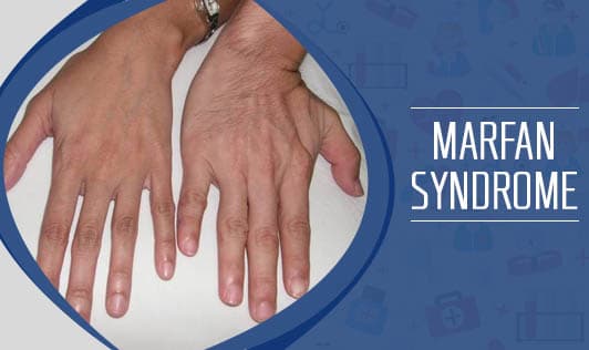 Marfan Syndrome