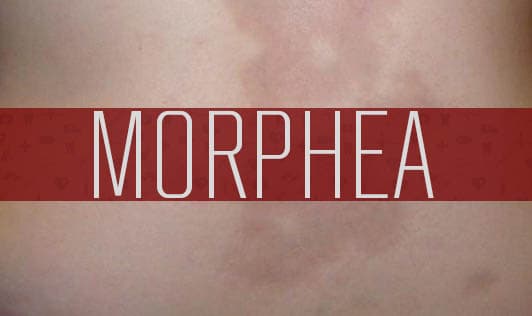 Morphea -  A form of Scleroderma 