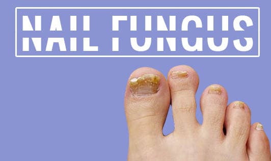 Nail Fungus