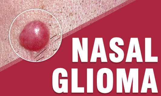 Nasal Glioma