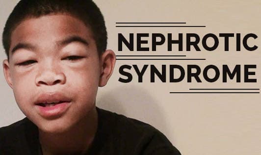 Nephrotic Syndrome
