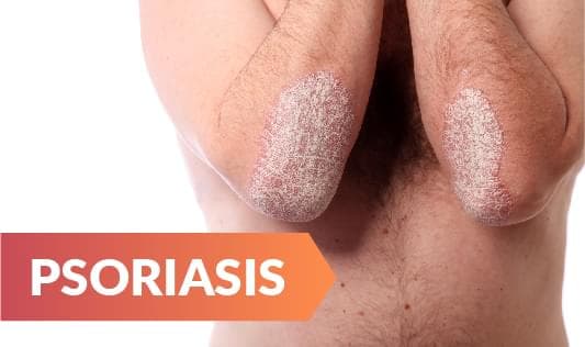 PSORIASIS