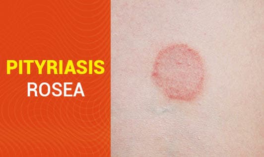 Pityriasis Rosea