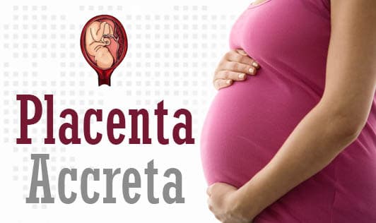 Placenta Accreta